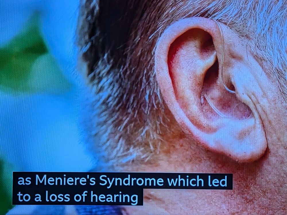 A screenshot of Chris Packham's ear, with the subtitles "as Menieres syndrome which led to a loss of hearing"