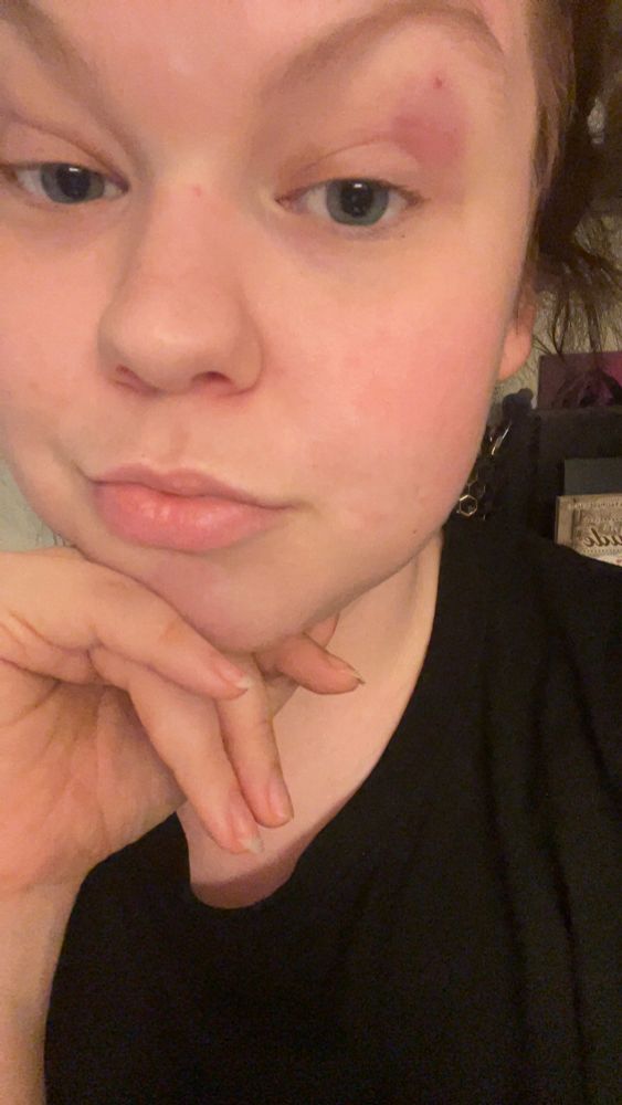 Selfie där mans ser att jag har ett litet sår och ett blåmärke på ena ögonlocket. 