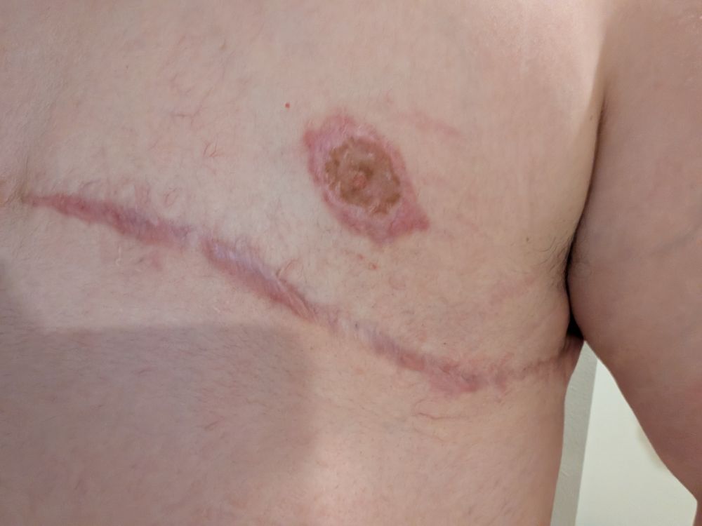 Even more hypertrophic scarring around a nipple graft