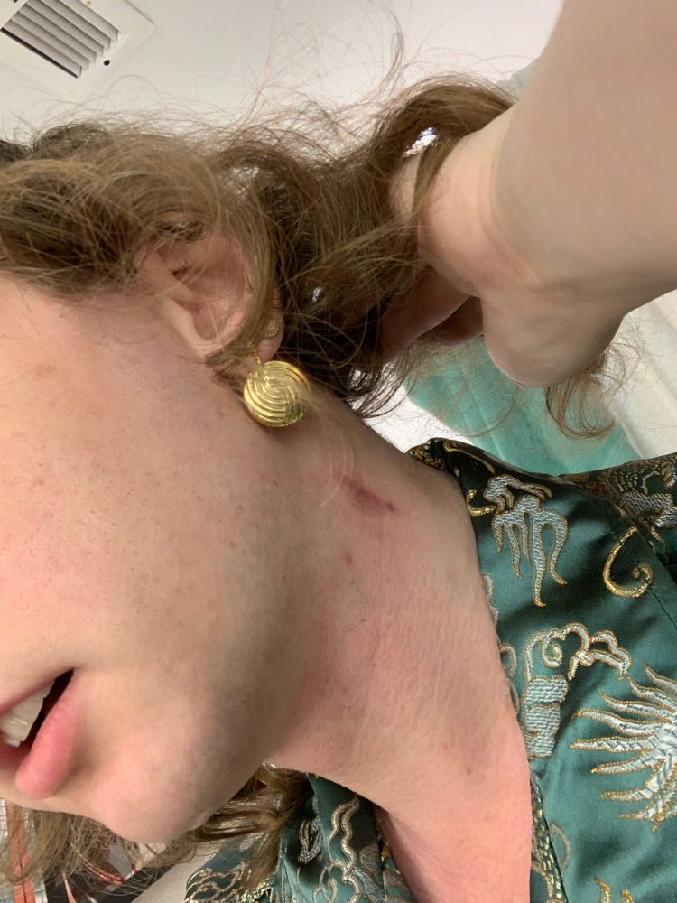 Bruise on my neck