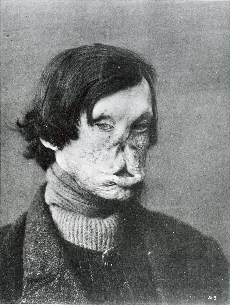  Tuberous Leprosy Description LEPROSY: Patient with tuberous leprosy. This file comes from the Wellcome Collection, a website operated by Wellcome Trust, a global charitable foundation based in the United Kingdom. https://wellcomecollection.org/works/n9sqqkra?wellcomeImagesUrl=/indexplus/image/L0032810.html Extracted from Leprosy In Its Clinical & Pathological Aspects by G. Armauer Hansen and Carl Looft, Wright and Co, Bristol, 1895, Plate III. Keywords: Patients; PATIENT; Leprosy; 19th century