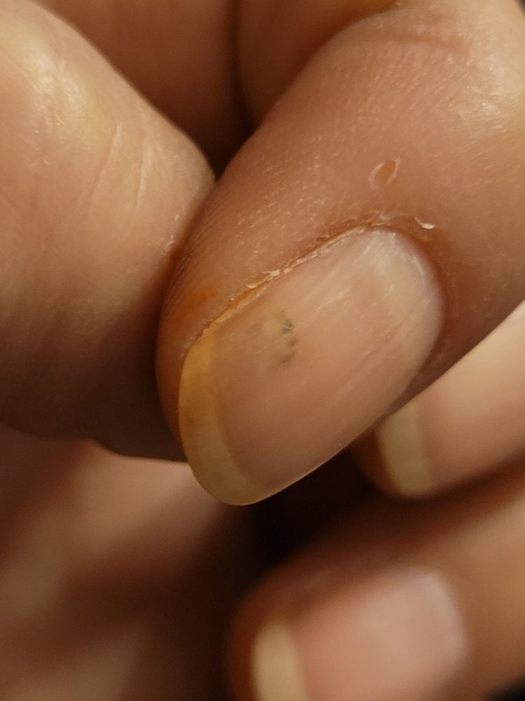 Fingernagel vom Zeigefinger mit fast rausgewachsenen blauen Fleck drin.