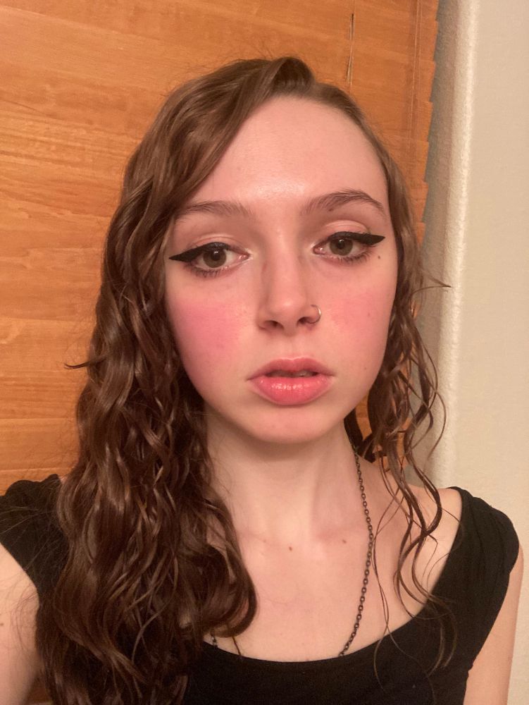 An old pic of me with a butterfly rash across my face. This is due to lupus. You can see that my malar rash is in early stages because it hasn’t completely wrapped around my nose, but is headed in that direction. 