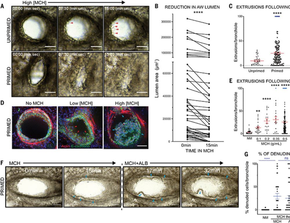 Bronchoconstriction damages airway epithelia by crowding-induced excess cell extrusion