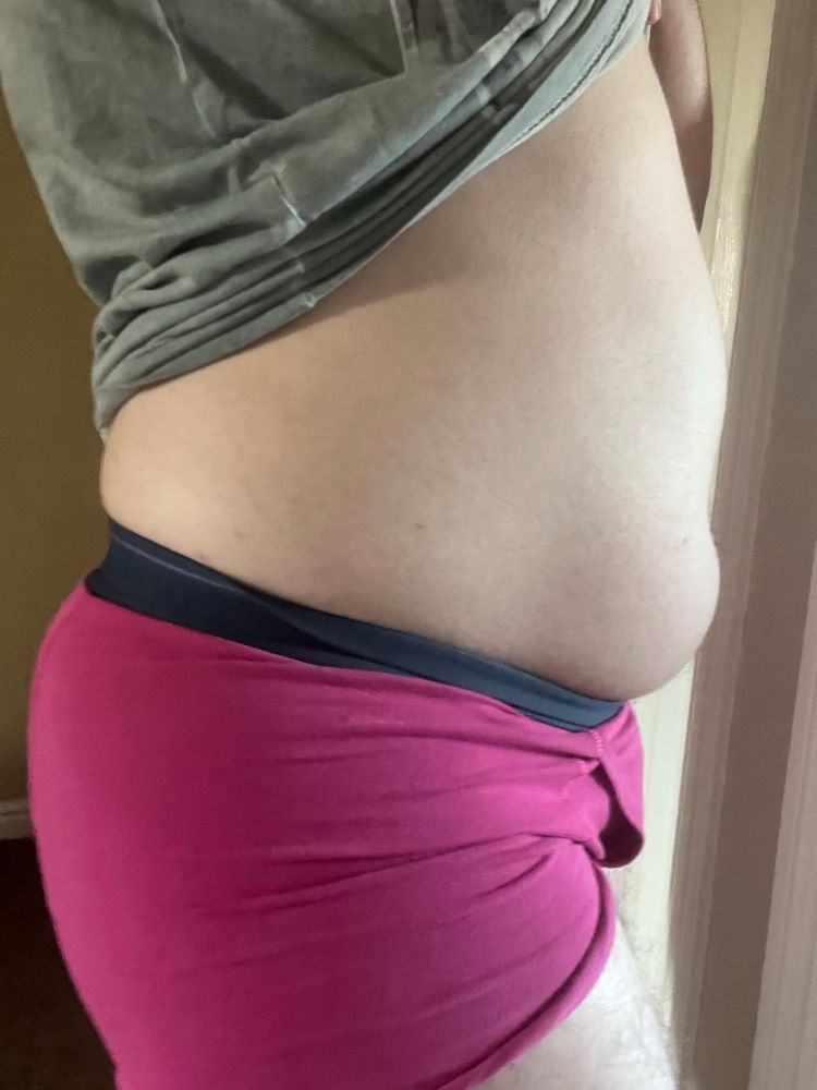 huge bladder bulge, side view