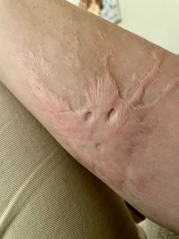 Photo of my forearm, showing a large, irregular keloid scar formed by a scald when I was a kid. In the center of the raised scar are three small round patches of healthy skin which look very approximately like a ghost going Ooooooooh