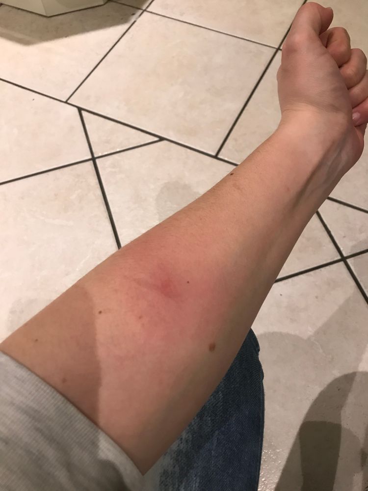 Photo of my forearm with a red tick bite surrounded by a mild rash