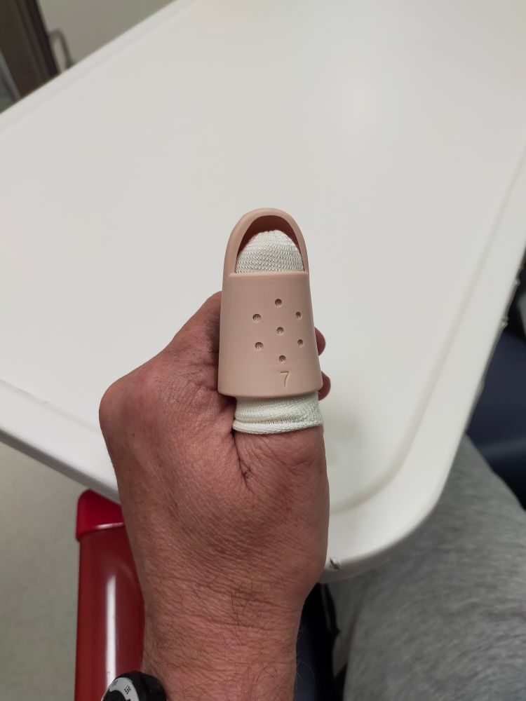 A man's thumb incased in a splint having been glued back together 