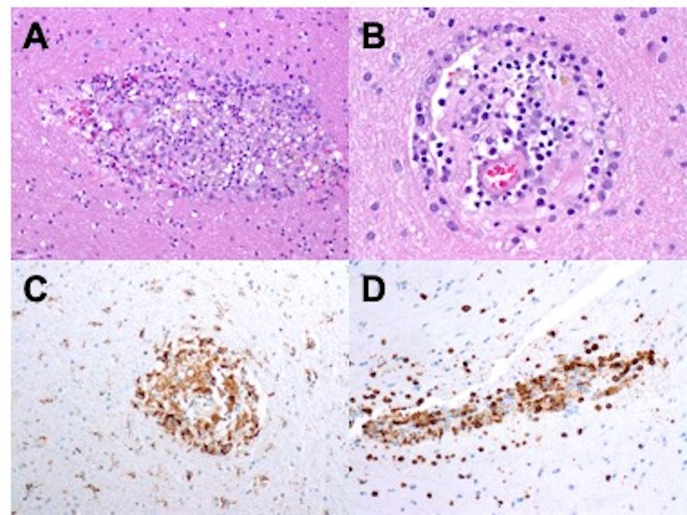 Histopathologic findings from right temporal lobe lesion brain biopsy in a 27-year-old woman with acute encephalopathy and painful bilateral cervical lymphadenopathy. Sections show brain parenchyma with patchy perivascular mononuclear, lymphohistiocyte-rich inflammation (A and B). Immunohistochemical staining highlighted CD68+ macrophages (C) and CD3+ T lymphocytes, including a mix of CD4+ and CD8+ populations (D), in prominent perivascular distributions.