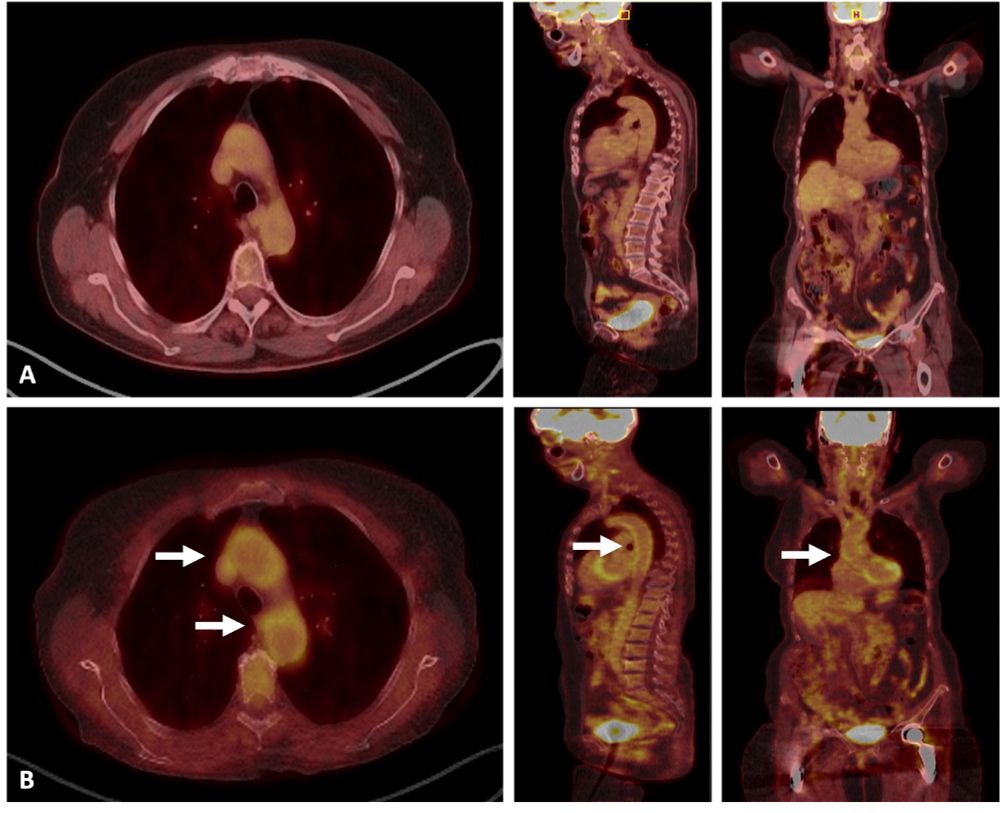 Figure 1. Large-vessel vasculitis relapse in a patient with GCA. Images show 83-year-old women with biopsy-proven GCA, whose disease onset was characterized by a 3-week history of headache, scalp tenderness, jaw claudication, and constitutional symptoms. A) Initial [18F]-fluorodeoxyglucose positron emission computed tomography (PET/TC), performed two days after the start of high-dose glucocorticoids (60 mg/day prednisone) showed no abnormal vascular or musculoskeletal uptake. B) One year after diagnosis, the patient relapsed with daily headache, polymyalgia rheumatica, fever, and elevated acute phase reactants. PET/TC demonstrates avid uptake of FDG in the ascending and descending aorta (arrows) as well as in the carotid arteries