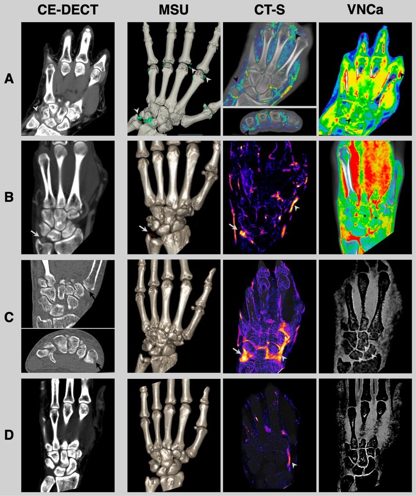 Imaging examples. MSU = monosodium urate reconstruction; CT-S = CT subtraction; VNCa = virtual non-calcium images to assess bone marrow edema.
A: A 65 y/o male with initially suspected PsA. In CE-DECT, crystals were visible in the region of the triangular fibrocartilage complex (gray arrow) and the 2nd & 3rd MCP joint, confirmed to be MSU crystals.
B: A 66 y/o male with initially suspected RA. CE-DECT revealed MSU crystals at the triangular fibrocartilage complex (gray arrows, indicated by red coding), with active inflammation detected in CT-S (gray arrow).
C: A 43 y/o female with initially suspected gouty arthritis. CE-DECT showed erosions at the base of the 1st metacarpal bone (black arrows).
D: A 30 y/o male with initially suspected AOSD. No abnormalities were detected in CE-DECT, leading to assumption of a normal finding. However, the patient ultimately received a final dx of AOSD. Contrast medium can be seen within vessels in CT-S (gray arrowhead) but not within the synovium 