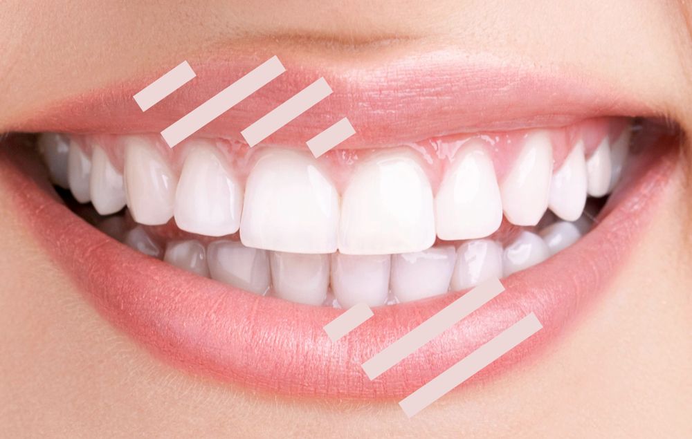 parallel street crossing lines painted diagonally across lips