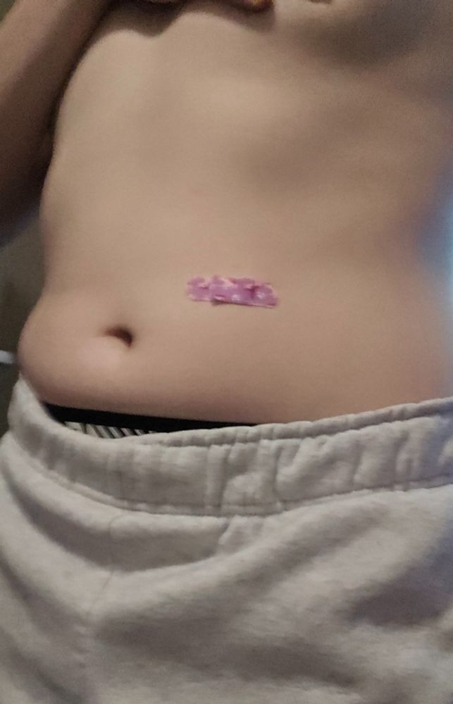 a picture of me shirtless, in white booty shorts. there's a pink cloth bandaid with unicorns on it on my tummy, covering the injection site