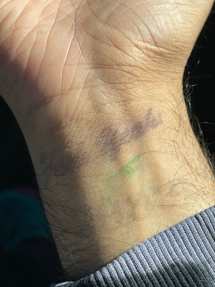wrist with a green stamp of an eye