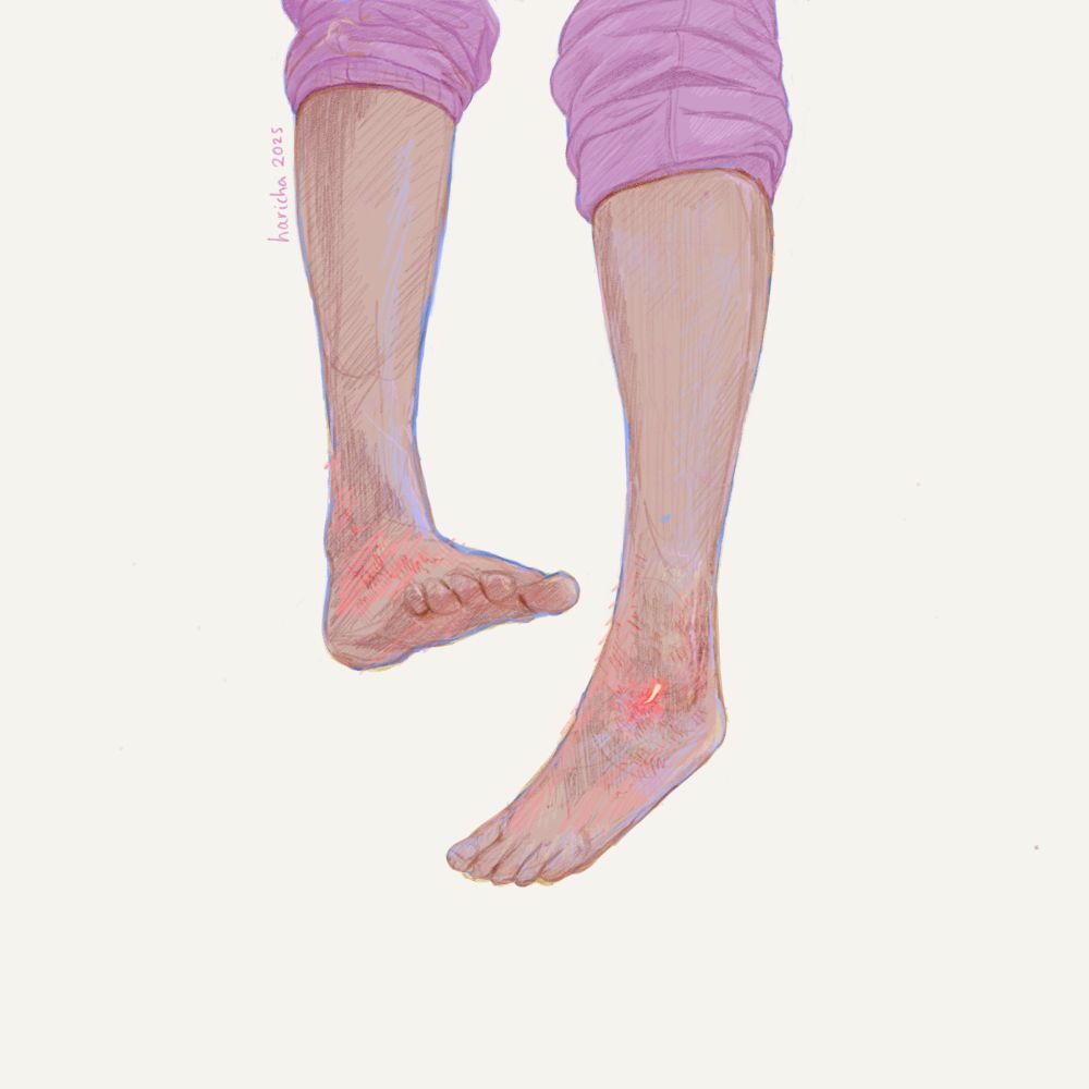 illustration of lower limbs with a bone spur 