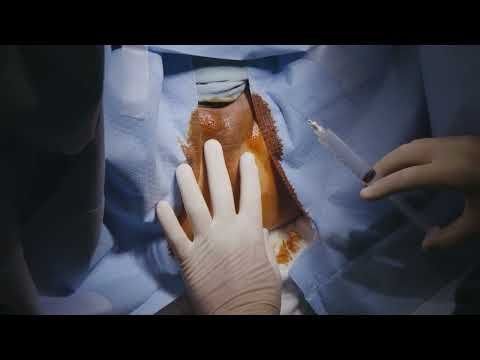 Transperineal Procedure - Gold seed Insertion or TP Biopsy. #1