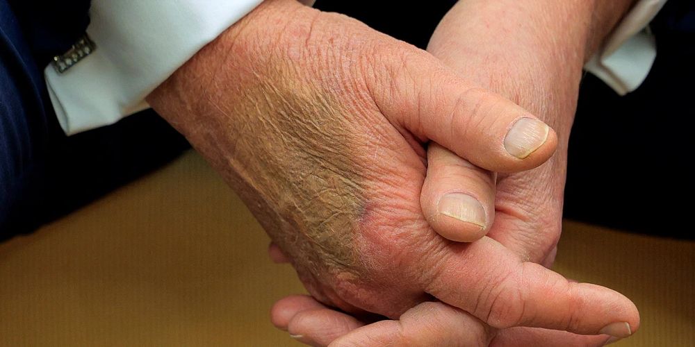 Right hand of Donald Trump with makeup smeared to hide removed Nazi tattoo.