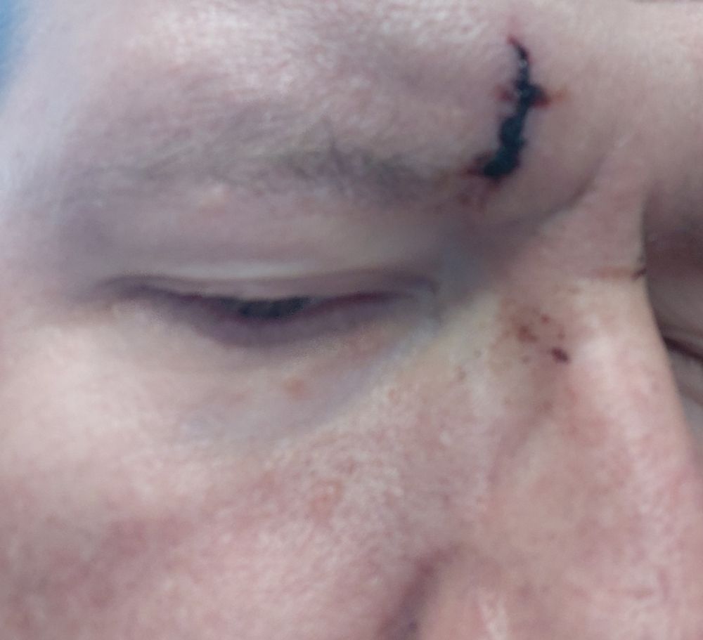 Picture of me with a nice little boo boo above my eyebrow.