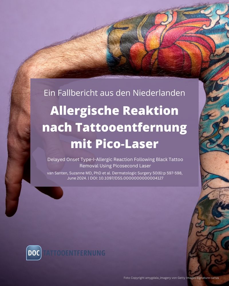 Allergische Reaktion erst Tage nach der Tattooentfernung mit Pico‑Laser?!

Ein interessanter Fallbericht aus den Niederlanden zeigt: Nach der Behandlung eines Blackwork Tattoos am Arm mit einem Pico Nd:YAG Laser kam es "verzögert" zu einer allergischen Typ‑I-Reaktion.

Ein bislang einmaliger Fall weltweit! 🌍⚡u.W.n.

💡 Die gute Nachricht: Pikosekunden-Laser gelten weiterhin als sehr sicher. Aber dieser Fall zeigt, wie wichtig Aufklärung, Nachsorge und Know-how bleiben. Auch bei modernster medizinischer Technologie.

🔍 Mehr dazu im Blog

#tattooentfernung #pikosekundenlaser #dermatologie #tattooallergie #laserbehandlung #typIallergie #seltenereaktion #tattooentfernen #hautgesundheit #doctattooentfernung #tattoorisiken #lasersafety #laserdermatologie #wissenistschutz #patientenaufklärung #medizinwissen #picolaser #tattoo #tätowierfarbe #tattoopoli