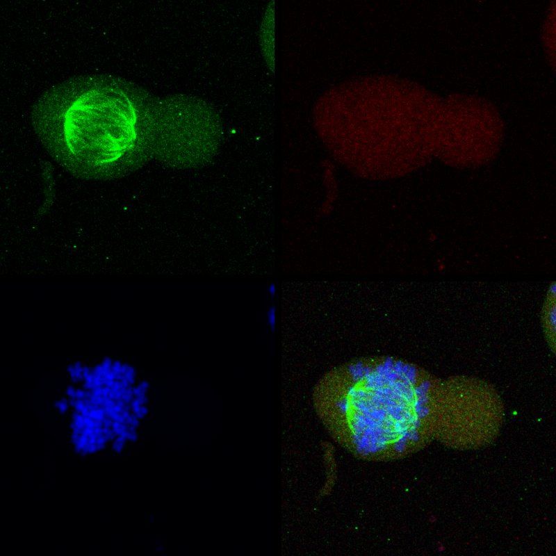 KT1 leukemic cell in mitosis showing spindle and chromosomes