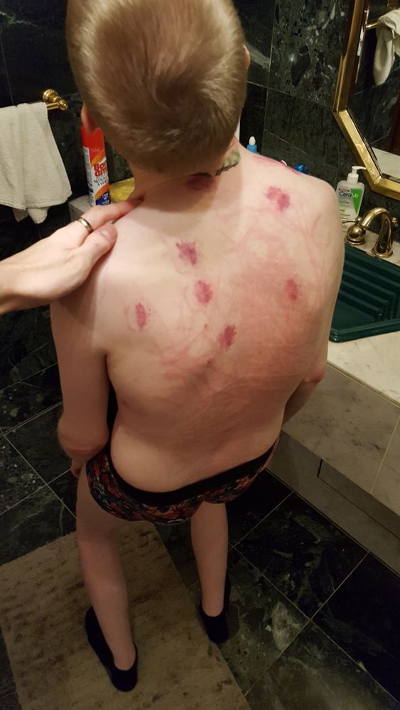 another photo displaying fresh marks, this with the user having a mark pressed on making their legs go weak