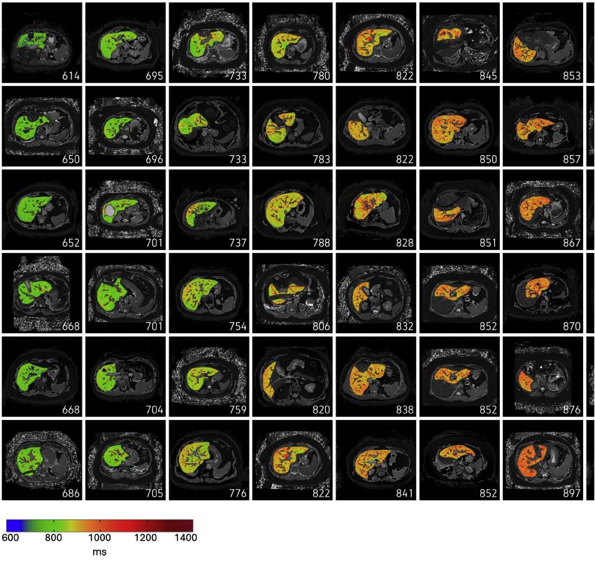 Discover new findings on at-risk MASH detection of patients in Digestive and Liver Disease