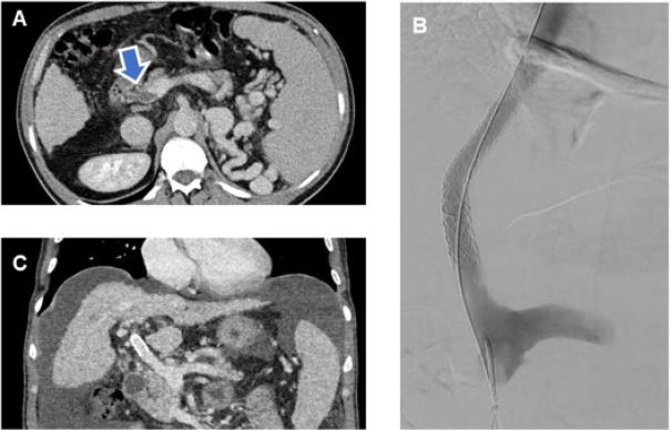 Read the latest on liver transplant advances in Digestive and Liver Disease

