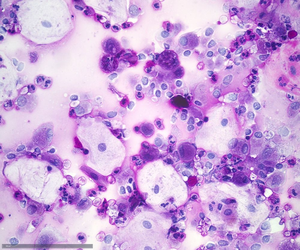 BAL with inflammatory backgound.. Lots of granulocytes.