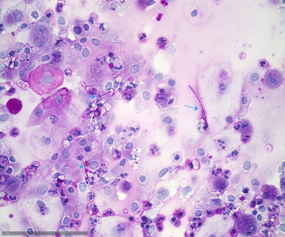 Arrows Candida pseudohyphae.