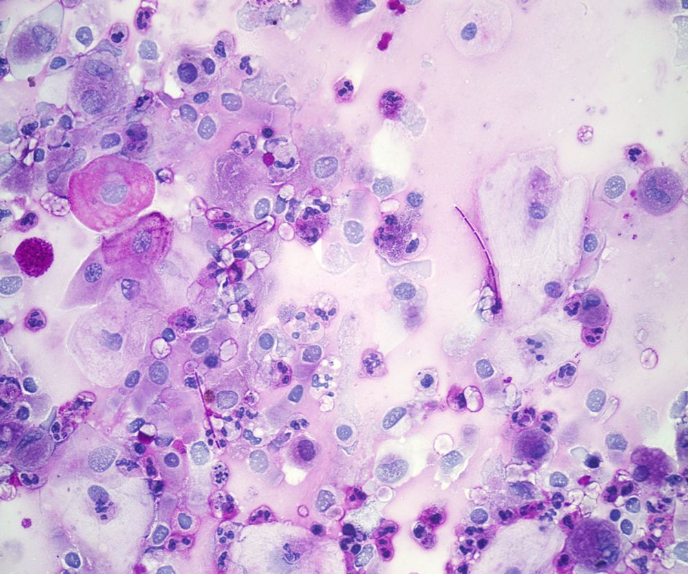 Fungal pseudohyphae likely Candida (can´t specify species).