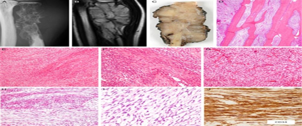 Novel NTRK3 Fusions in Fibrosarcomas of Adults : The American Journal of Surgical Pathology