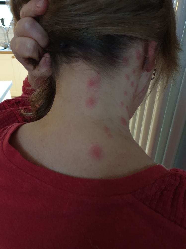 Lady with shingles on hrr neck