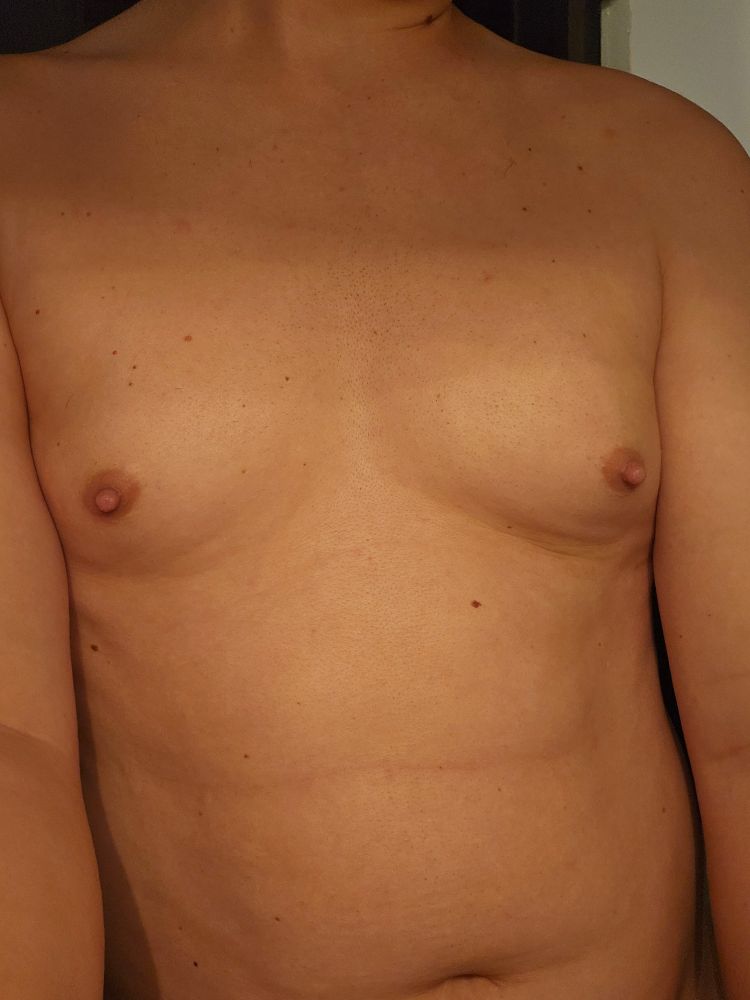 Transfemme tits 3 months into hrt 