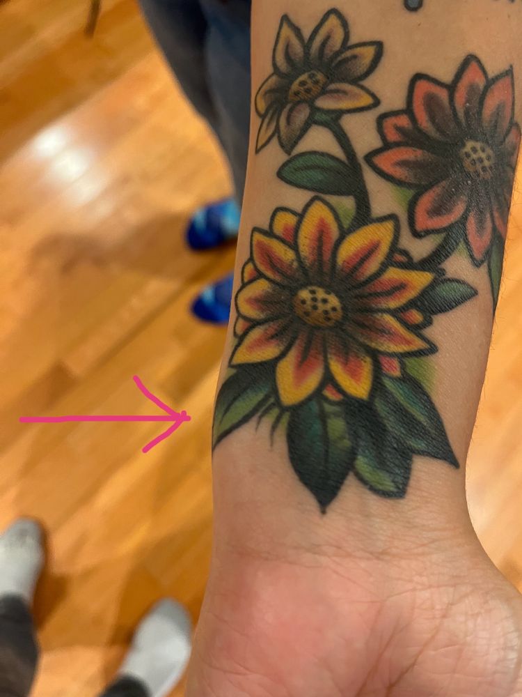 Photo of a wrist with an arrow pointing to swelling on the medial side. 