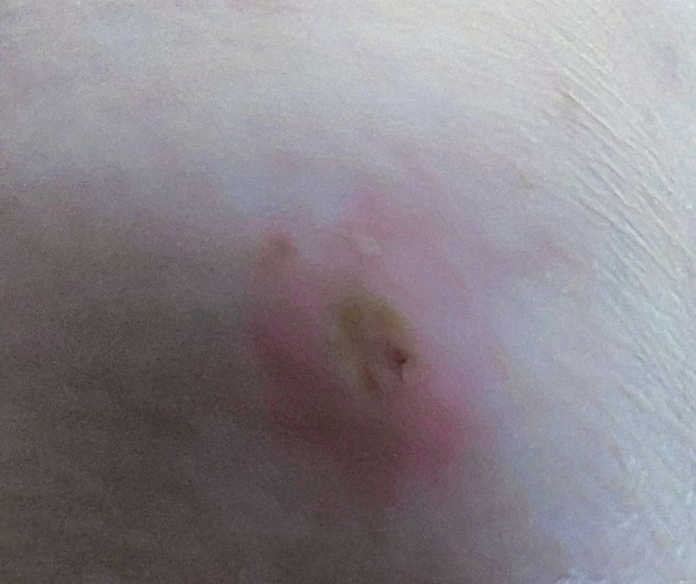 Hautpartie am Knie mit 2 vermeintlichen Mückenstichen nebeneinander.