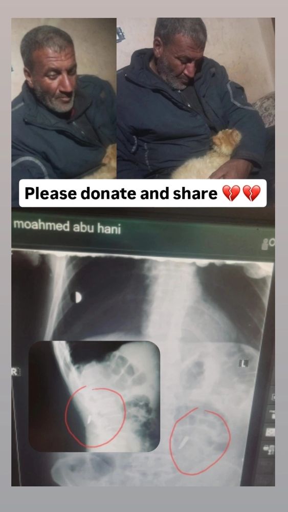 This is my beloved father, Mohammed Abu Hani.
He was shot in the back while trying to bring us food in the middle of the famine.
He risked everything just to keep us alive, and now he is the one fighting to survive.
My father needs your compassion.
Every donation, every share, could be the lifeline that reaches him in time.
Please… help us, donate if you can, and share our plea with the world.
Your kindness could save a life.