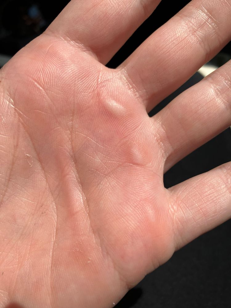 Hand calluses
