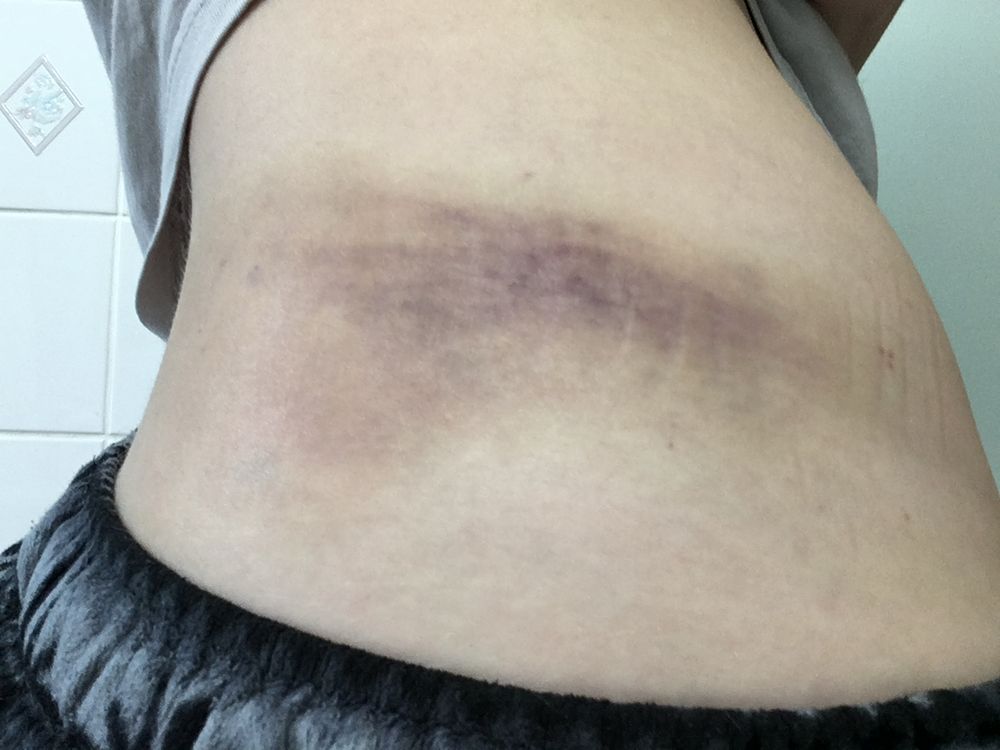 Bruised side