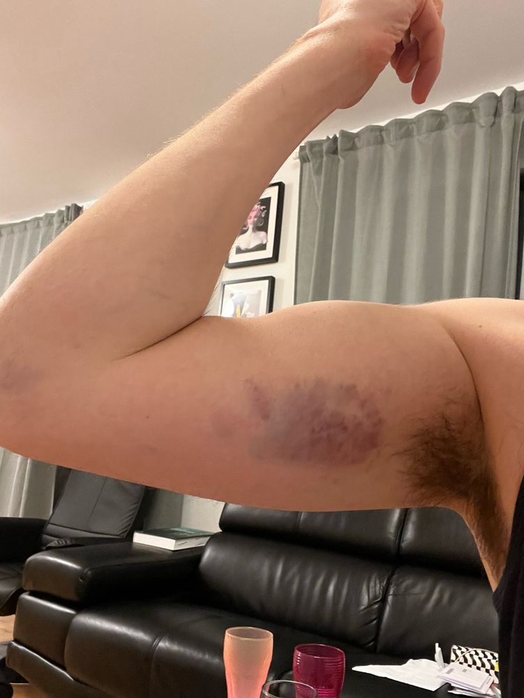Arm mit Hämatom