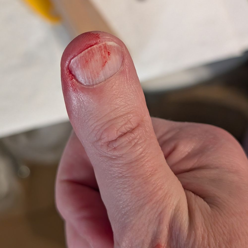 smashed and bleeding thumbnail from hitting it on build plate while scraping parts off