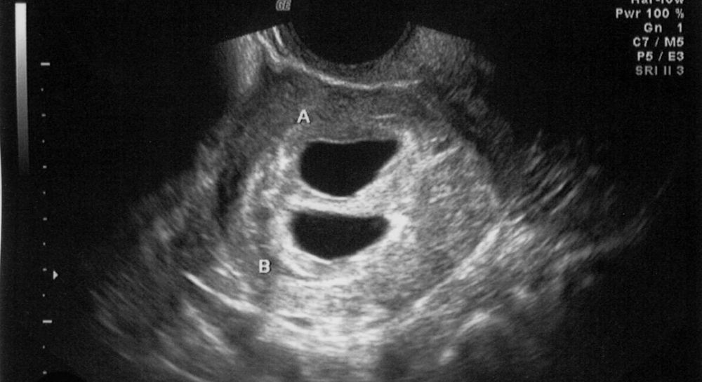 Ultrasound photo