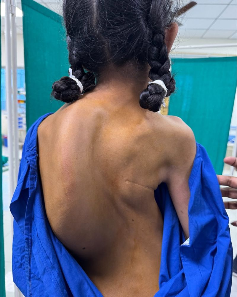A patient with scoliosis 