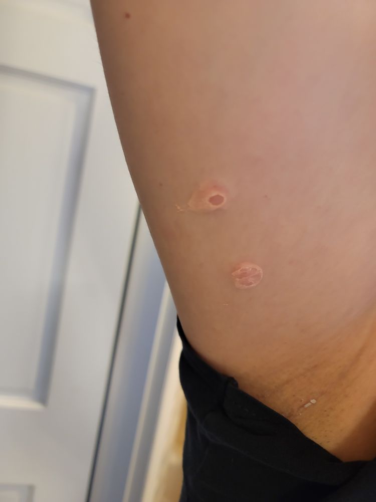 My flabby underarm with another 2 mosquito bites