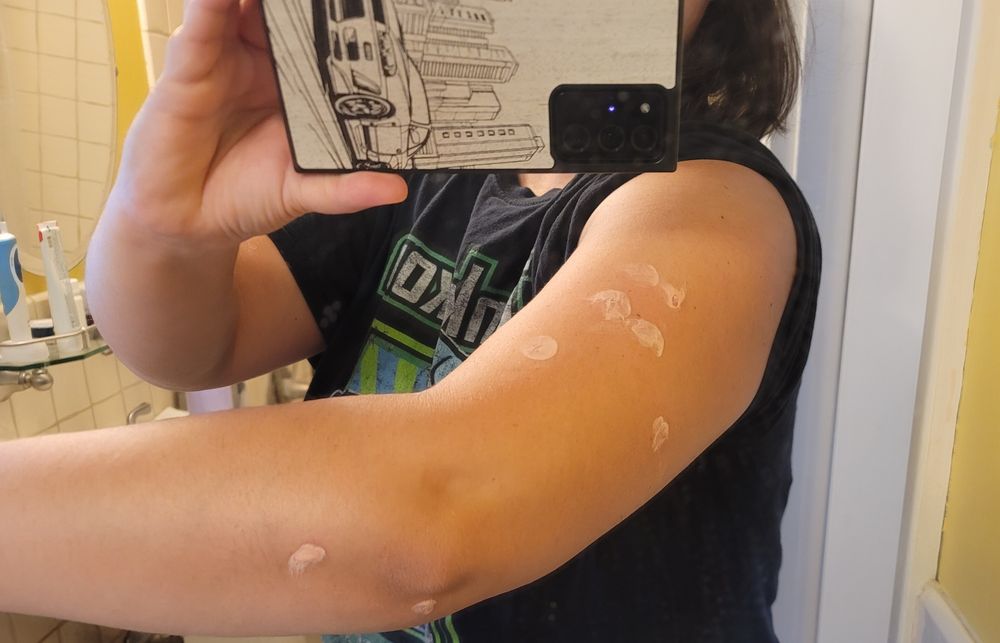 An arm with 8 calamine-covered mosquito bites on it