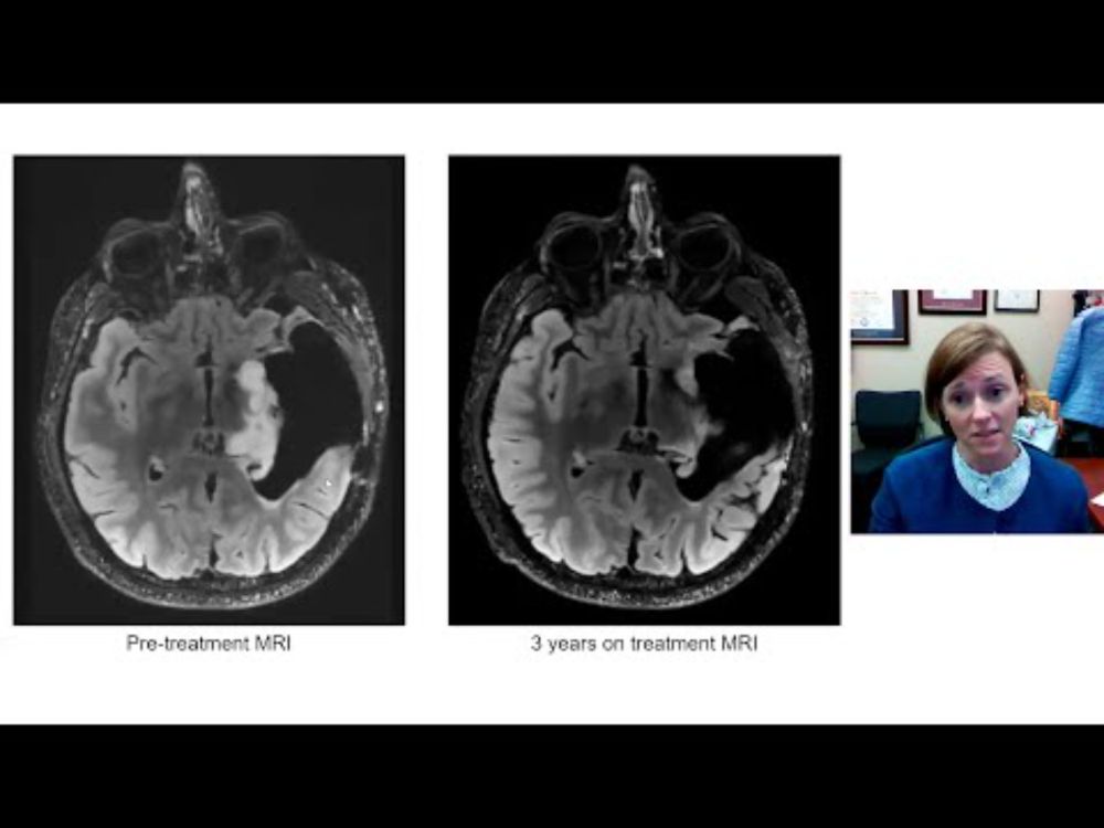 Impact of Glioma Molecular Profiling | UCSF Neurosurgery Community Grand Rounds
