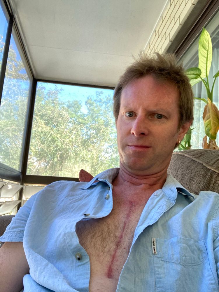 Me with my shirt unbuttoned shortly after open heart surgery, showing off my seven-inch scar. You don’t wanna see the hospital post-op selfies 