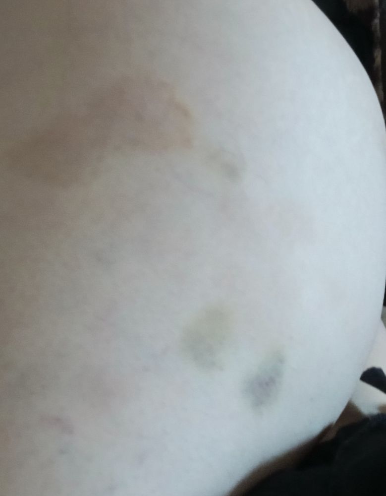 Ein Oberschenkel mit älteren blauen Flecken und zwei neueren blauen Halbmonden