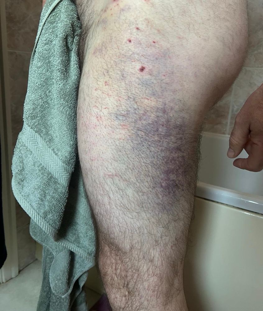 A bruised white male’s thigh, taken in a bathroom. 
The bruise is going dark blue and purple 
It stretches from hip to knee. 