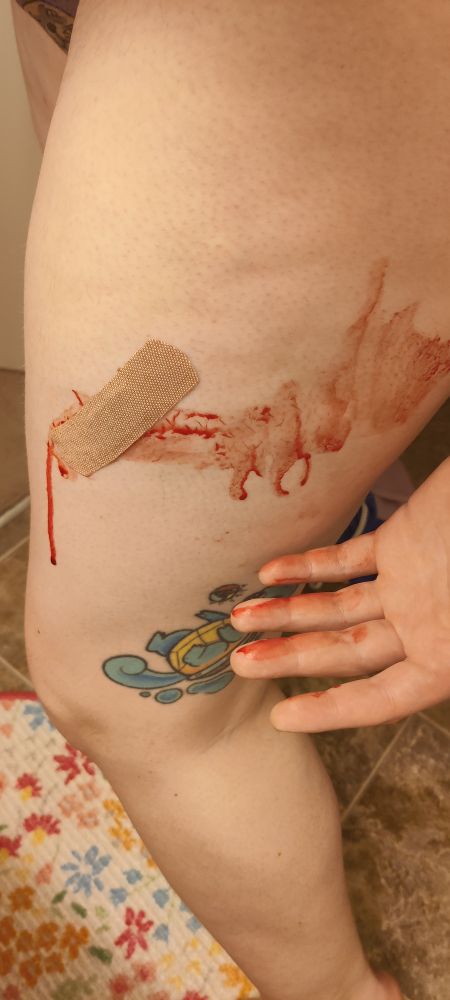 My thigh, post-injection, with blood smeared all over 