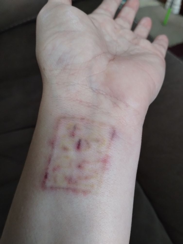 Photo of my wrist after laser tattoo removal. Ink areas are now a purple red from bruising.